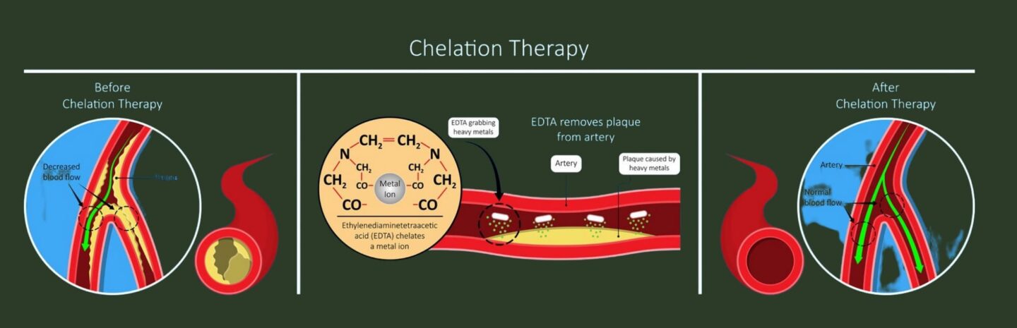 Chelation Therapy Functional Medicine Gaffney Sc 1